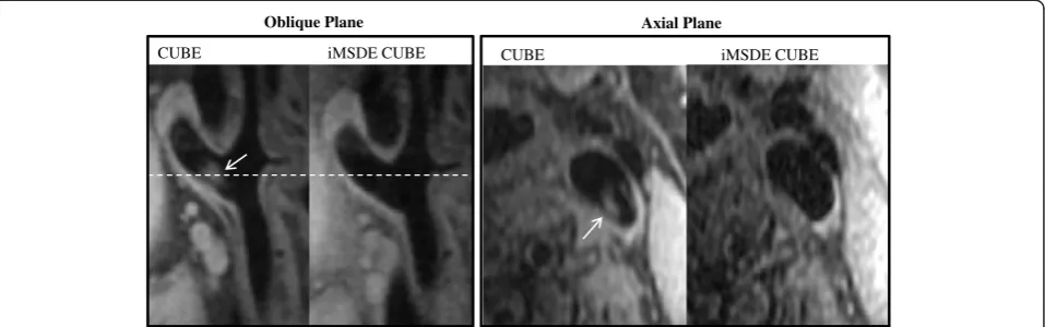 Figure 9 Example images of 3D T1-w CUBE and iMSDE prepared CUBE images in a volunteer