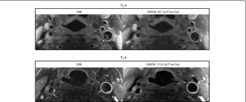 Table 4 Comparison of muscle and wall SNR/CNReff in patients using optimized iMSDE and DIR (six patients)
