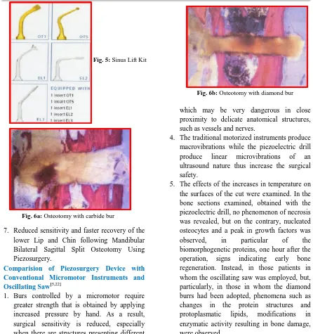 Fig. 6b: Osteotomy with diamond bur  