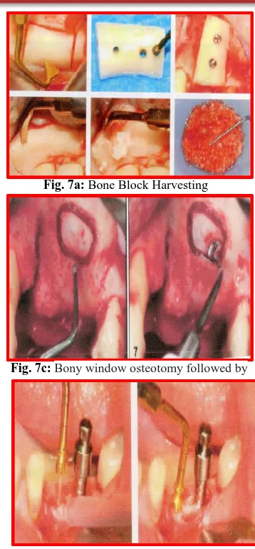 Fig. 7a: Bone Block Harvesting  