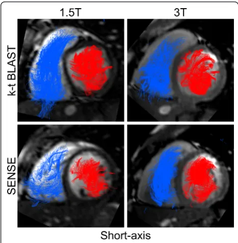 Figure 5 Visualization of intra-cardiac 4D-flow using particletracing with four-chamber cine images for anatomicalreference, in the same subject as Figure 6