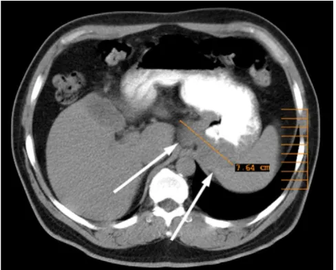 Figure 2Initial CT-ScanInitial CT-Scan. Initial CT scan showing the advanced tumor of the esophagogastric junction before starting neoad-juvant therapy.