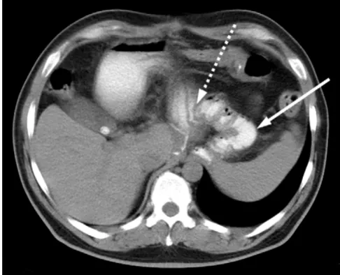 Figure 6Postoperative CT-ScanPostoperative CT-Scan. Postoperative follow-up CT scan after 18 months showing the jejunal interposition (gastro-jejunostomy: interrupted arrow).