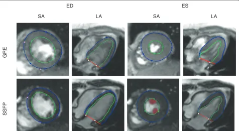 Figure 1 Image and shape differences for a volunteer imaged both with GRE (top), and SSFP (bottom), for the same short-axis (SA),long-axis (LA) planes at end diastole (ED) and end systole (ES)