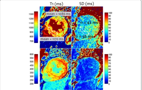 Figure 8 Example T1-map and SD map for subject with myocarditis and focal abnormality corresponding to T1 elevation (103 ms)between lateral wall and septum of 2.4 SD on a pixel-wise basis (lateral wall SD = 43 ms).