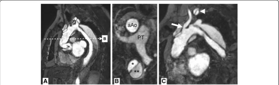 Figure 9 MR-angiography.breath-held 3D gradient recalled echo sequence after contrast injection