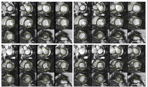 Figure 1 Left ventricular (LV) chamber quantification. For LV chamber quantification, the endocardial (blue) and epicardial (yellow) contoursare delineated in diastole (top) and systole (bottom) in a stack of short axis slices that cover the whole left ven