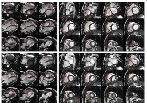 Figure 2 Right ventricular (RV) chamber quantification. For RV volume quantification, the endocardial (red) contours are delineated indiastole (top) and systole (bottom) in a stack of transaxial (a and b) or short-axis (c and d) slices that cover the whole RV.