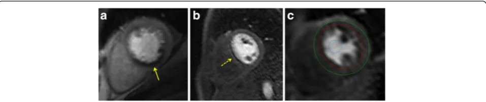 Figure 3 Perfusion imaging. a) Perfusion defect in the inferior segments (yellow arrow)