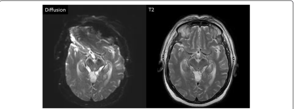 Figure 3 Left: Diffusion weighted gradient echo image. Notice pacemaker associated distortion of the image in the frontal region of thebrain