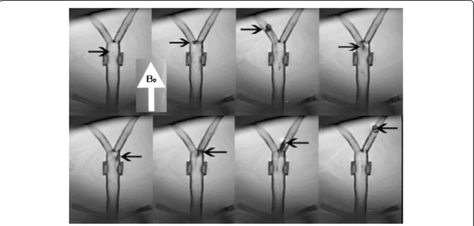 Figure 4 Navigation of magnetic catheter under steady state free precession real-time imaging in an aortic bifurcation phantom withcatheter (arrow) when no electric current is applied