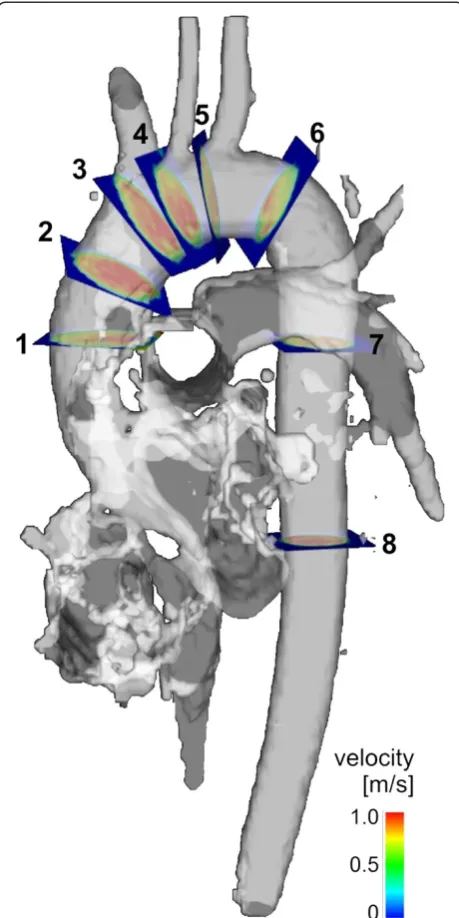 Figure 2 Vortex and supra-physiologic-helix flow. Early (leftcolumn) and late (right column) systolic time-resolved particle tracesshow the formation of a large flow vortex encompassing the entireAAo (A, white arrows, grading = 1.5) in an aneurysm patient 
