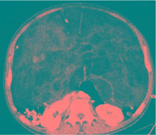 Figure 1CT scanCT scan. Heterogeneous lesion is observed with zones of fat and solid density that entirely occupy the abdominal cavity, dis-placing retroperitoneal structures dorsally.