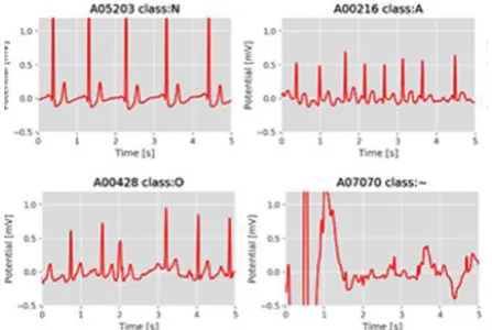 Fig 1. rhythm (class N),Atrial fibrillation (class A), Other rhythms  Four classes of the data set such that Normal sinus (class O), or Too noisy (class ~) 