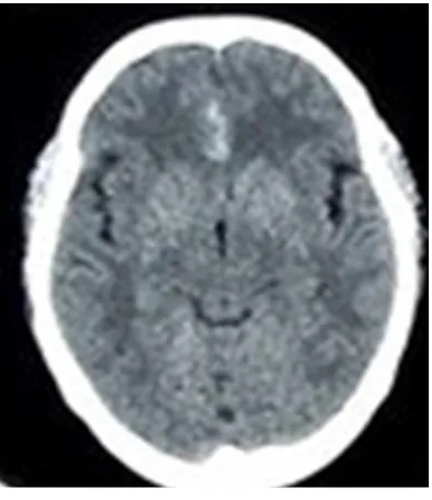 Figure 1. CT scan of brain shows subarachnoid hemorrhage and hematoma in the interhemispheric fissure