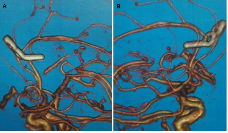 Figure 3. (A) 3D CT angiogram demonstrating a saccular aneurysm arising from the bifurcation zone of azygos ACA; (B) 3D CT angiogram showing a 5.9 by 7.4 mm saccular aneurysm