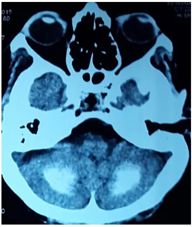Figure 3. Computerized tomography scan of cerebellar calcification