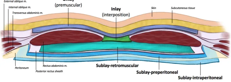 Figure 1. Abdominal wall demonstrating mesh planes