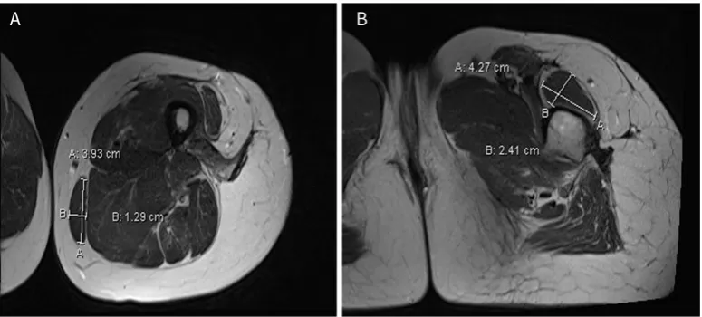 Figure 8. Demonstration of leg extension after free functional gracilis muscle flap to left quadriceps position at three years post-surgery: (A) leg at rest; (B) full active extension of leg; and (C) skin paddle of flap 