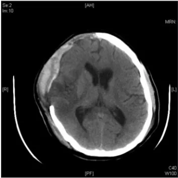 Figure 2: Postoperative computed tomography of brain after 3 days showing resolution of the mass effect with no midline shift