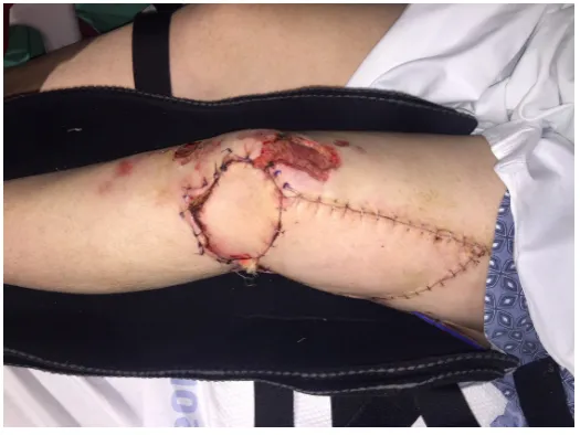 Figure 14. The flap was then rotated inferiorly into the first defect. The two other defects were connected