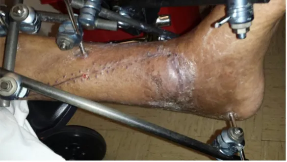 Figure 3. One-month post-operation: There is good healing over the wound without any distal necrosis