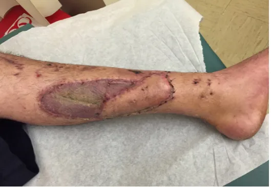 Figure 5. A propeller flap was designed on a posterior tibial perforator. The flap was isolated circumferentially on the perforator