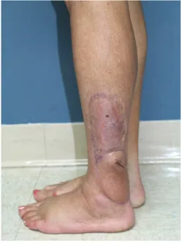 Figure 10. Peroneal artery perforator flap rotated 180 degrees into the wound. The blue “X” denotes the local of the peroneal artery perforator