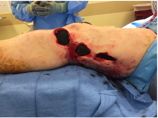 Figure 12. Traumatic wound of the left lower extremity after a motor vehicle collision