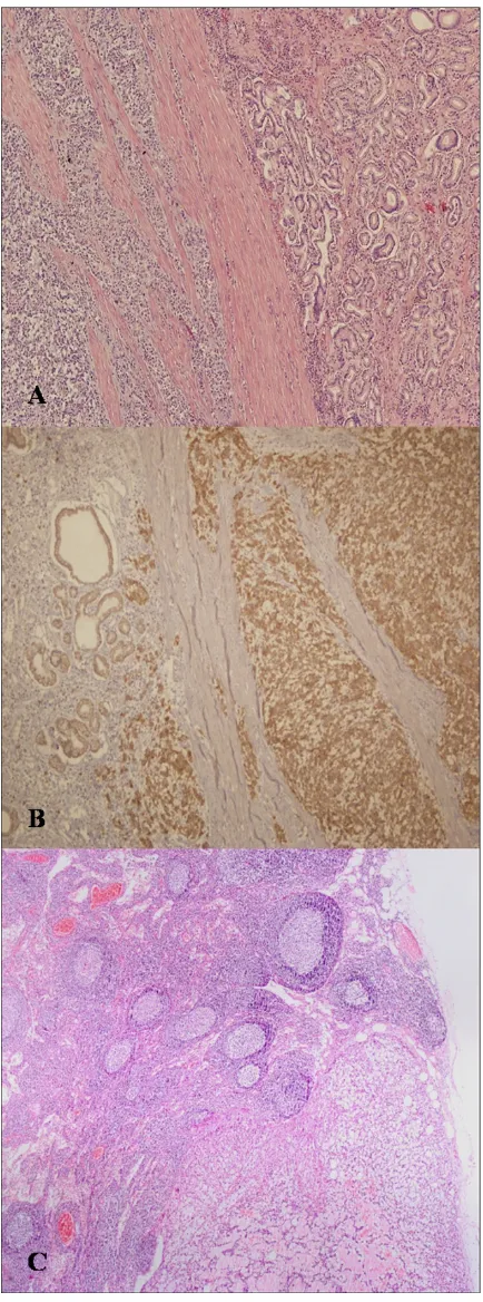 Figure 2The histopathological examination of the tumorThe histopathological examination of the tumor.A: A photomicrograph of the tumor showing epithelioid cells with prominent pleomorphism; mitotic index was 25 mitoses/50 hpf and MiB1 (Ki-67) index was hig