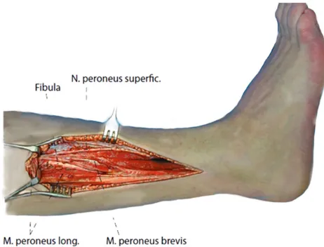 Figure 1. Anatomy of the lateral lower leg with marked peroneus brevis muscle