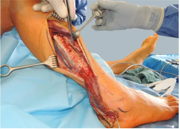 Figure 4. Dorsal aspect of the reconstructed heel region 6 months after surgical therapy 