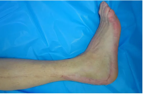 Figure 5. Lateral aspect of the lower leg and foot 6 months after reconstruction with the distally based peroneus brevis muscle flap and split-thickness skin graft