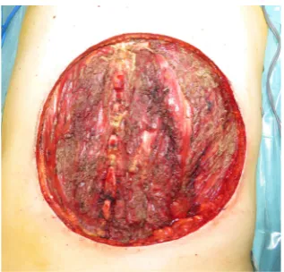 Figure 3. The tumor was widely resected. Intraoperative specimen 