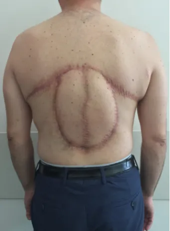 Figure 5. A bilateral reverse myocutaneous latissimus dorsi flap measuring 24 cm × 10 cm has been raised after tumor resection