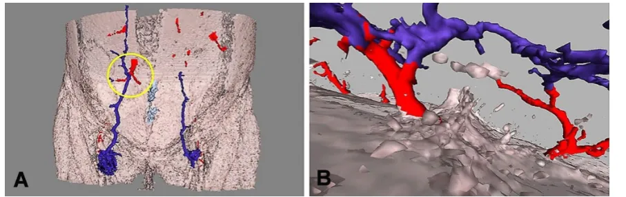 Figure 1: Deep inferior epigastric artery perforator flap exhibiting diffuse venous congestion