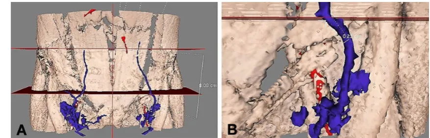 Figure 3: Three-dimensional abdominal wall reconstruction with AYRA software from computed tomography angiography images showing direct venous communication of the superficial inferior epigastric vein across the abdominal midline