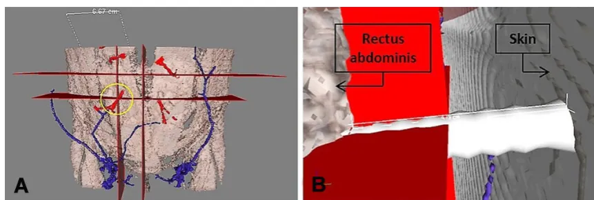 Figure 6: Three-dimensional abdominal wall reconstruction with AYRA software from computed tomography angiography images
