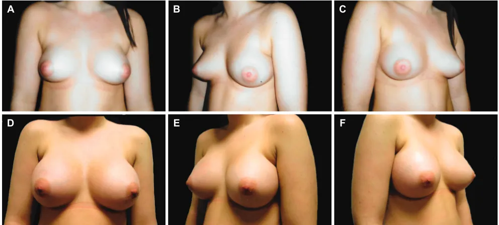 Table 2: Comparative analysis of implants sizes used in patients with symmetrical and asymmetrical breasts who were treated with mammoplasty alone