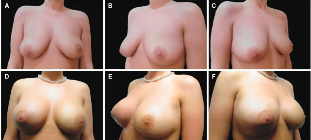 Table 5: Comparative analysis and relative distribution of different size implants used in asymmetrical breasts with ptosis (group B1 and B2)