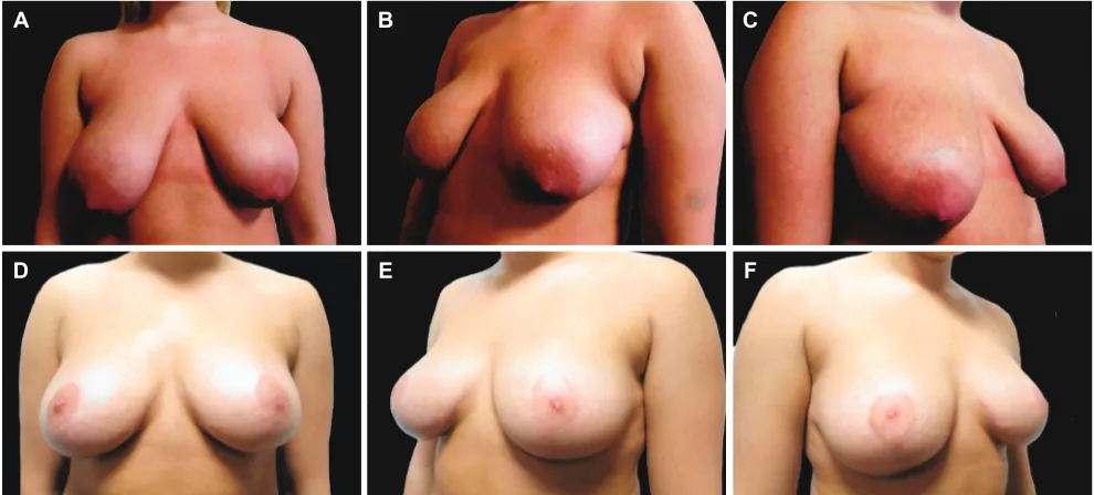 Table 7: Relative incidence of larger volume implant used on respective sides based on the volume of the prosthesis used in asymmetrical breasts