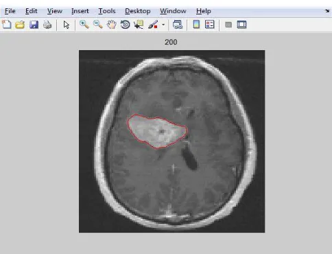 Fig. 6: Filtered Intensity Image for Brain showing Tumor Regions 