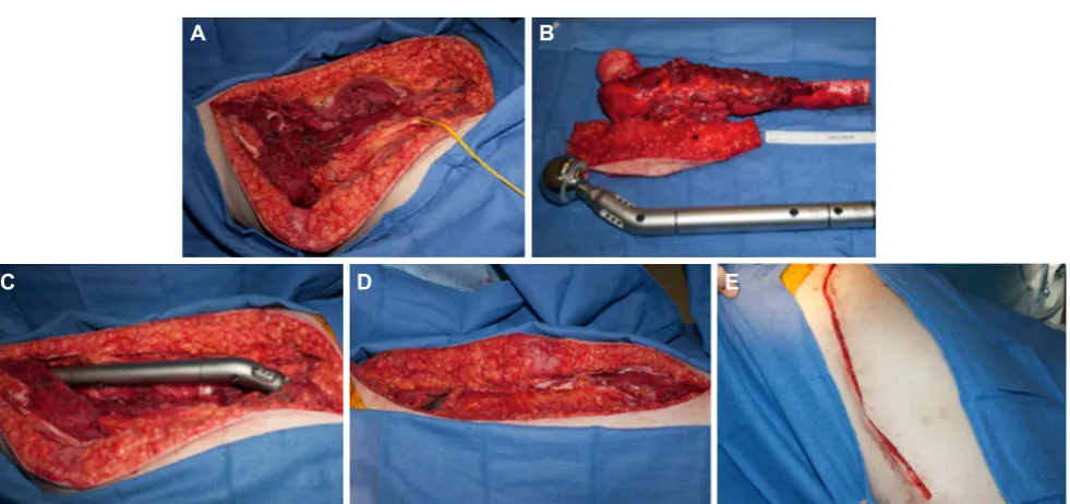 Figure 2: Bone and soft tissue reconstruction of distal tibia defect. A: bone reconstruction is performed with Phenix™ bone transport rod; B: endoprosthesis is covered in muscular and soft tissue envelope, and skin is closed with primary closure; C: photo at 3-month follow-up