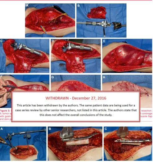 Figure 3: Proximal tibia osteosarcoma resection and reconstruction with endoprosthesis