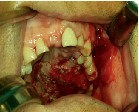 Figure 1: Intraoperative photograph of a patient with T4 squamous cell carcinoma of the hard palate with cervical metastases