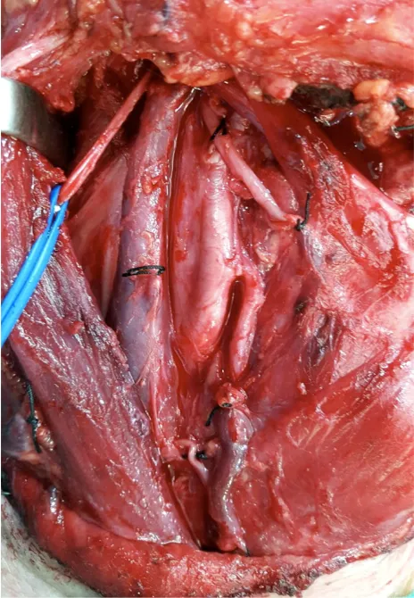 Figure 3: Completed selective supraomohyoid neck dissection, with extirpation of fibro-fatty tissue and lymph neck nodes from levels I to III, while preserving the sternocleidomastoid muscle, accessory spinalis nerve and internal jugular vein