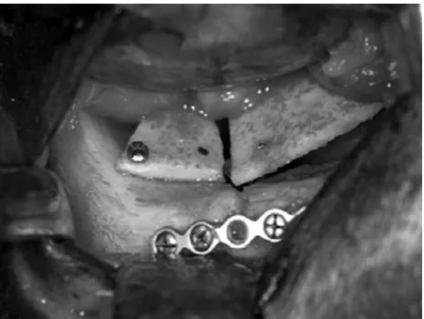 Figure 1: Multiple small plates of calvarial bone and screws were used to re-create the normal contour of the orbit