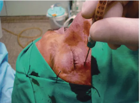 Figure 3: Example of polyethylene for reconstruction of internal orbital defect. (A) Shaped and sized polyethylene; (B) material in the orbit with bone screwed intaoperatively