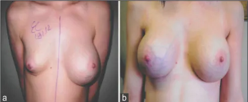 Figure 1: (a) Preoperative picture of a patient interested in augmentation mammoplasty; (b) postoperative picture showing left inframammary wound break down 4 weeks following augmentation mammoplasty when 300 mL round textured cohesive gel silicone implants were used; (c) completely healed wound following conservative treatment; (d) final result 3 months following augmentation mammoplasty