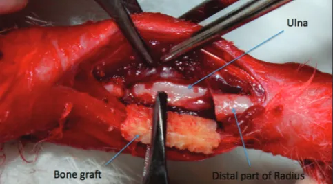 Figure 1: The procedure for the transplantation of cancellous bone graft into the segmental radial defect